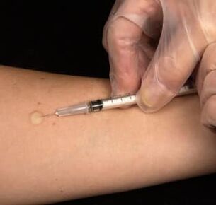 Subcutaneous injection of testosterone